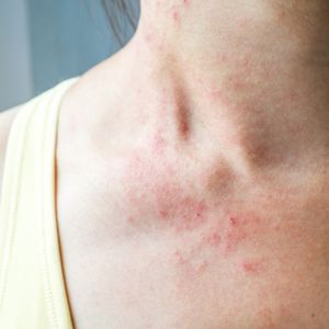 Allergies sur le cou et le buste